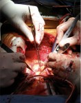 операция на сердце